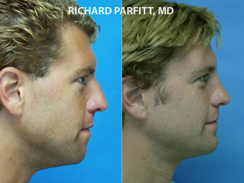 Chin Implant Photos Parfitt Facial Plastic Surgery Center