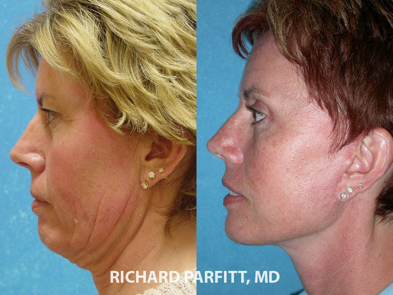 What is the cost of a facelift or neck lift?