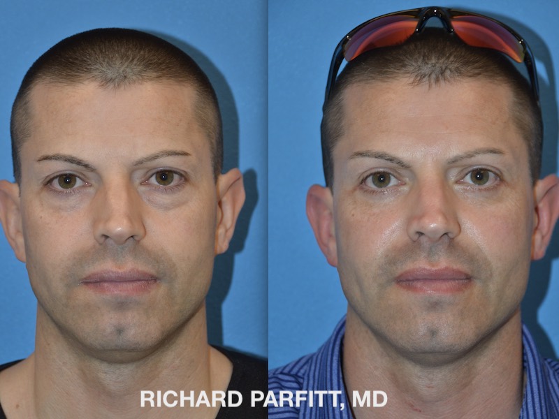 Male Plastic Surgery Before and After Photos