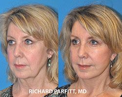 Madison WI dramatic facelift before and after facial plastic surgery