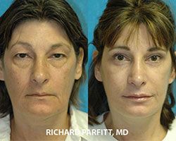facial rejuvenation before and after Dr Parfitt