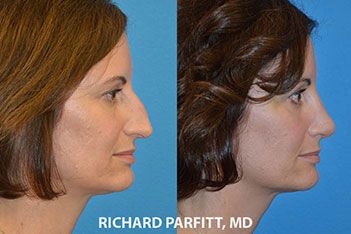 plastic-surgery-before-and-after-rhinoplasty
