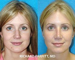 female nose job before and after cosmetic surgery Wisconsin