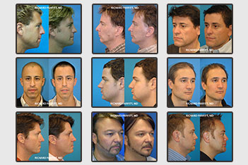 Male Facial Procedures