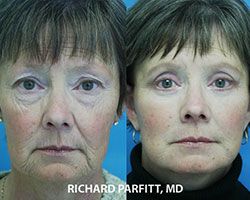 blepharoplasty facelift before and after plastic surgery Dr Parfitt