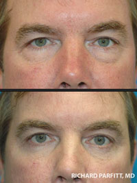 male before and after eyelid surgery