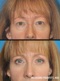 eyelid surgery before and after WI