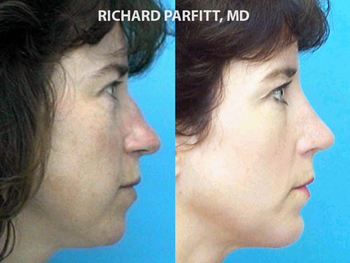 WI before and after chin implant