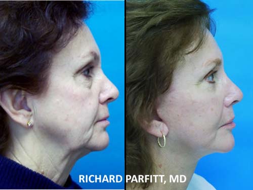 facelift Madison WI