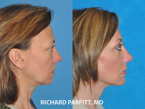 facelift before and after surgery WI