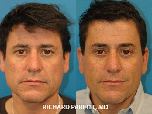 Male Plastic Surgery -forehead lift