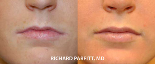 lip augmentation ( Implants )before and after