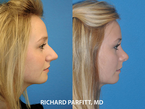 rhinoplasty nose job WI 2