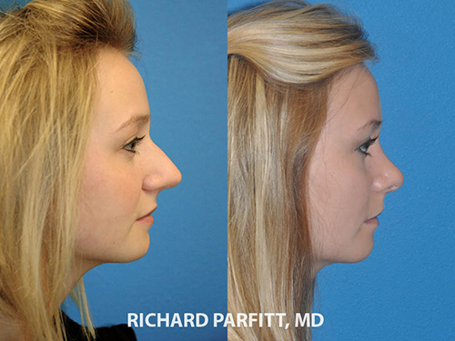 rhinoplasty before and after