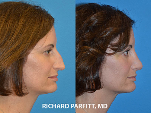 before and after rhinoplasty nose job