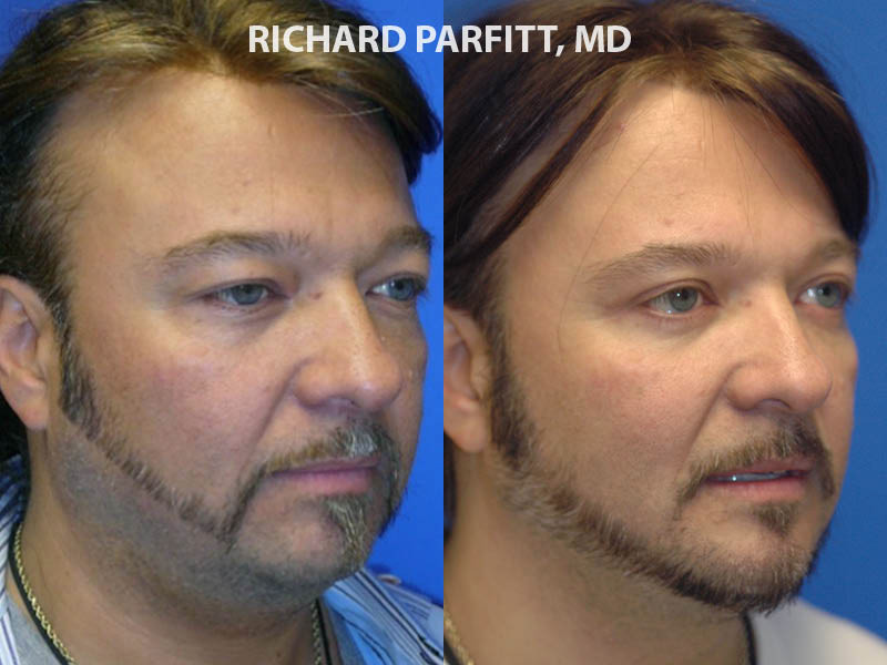 cheekbone implants men before and after