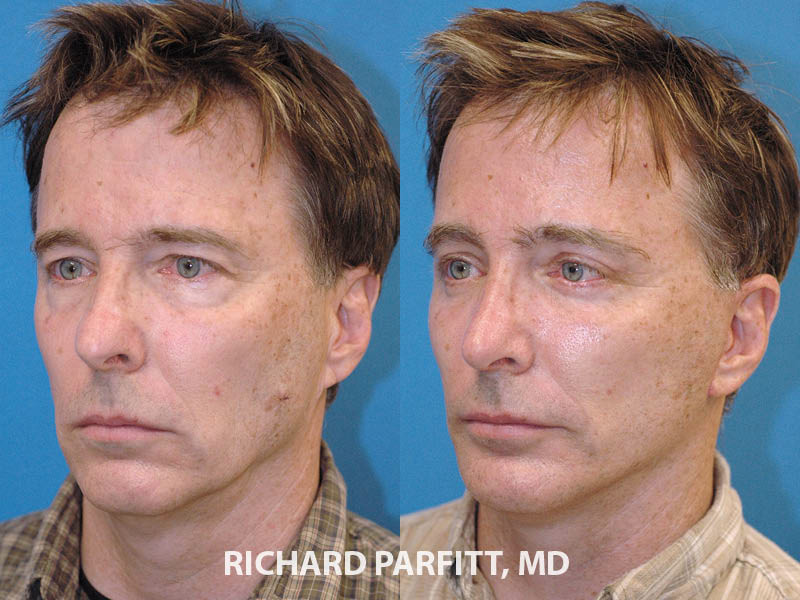 cheekbone implants men before and after