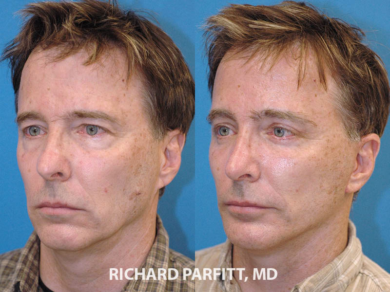 Facial Plastic Surgery for Men Before and After Photo Gallery