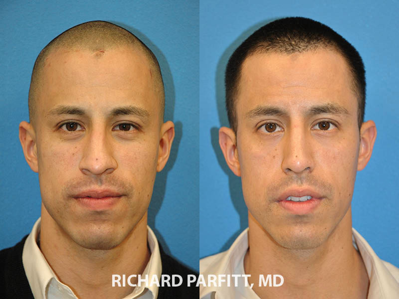 Male Plastic Surgery Before and After Photos