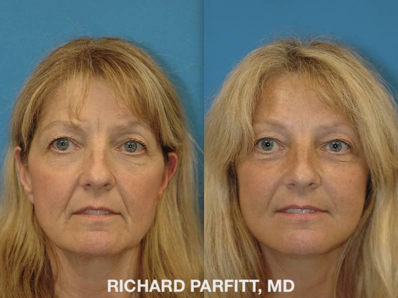 Facelift Before and After Photos - Dr. Richard Parfitt