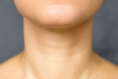 Submental Neck Liposuction