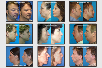 Chin Implant Photos