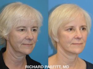 <strong>Procedures: </strong> Facelift/Neck Lift, Upper and Lower Blepharoplasty (eyelids) Before and after facelift and Upper and Lower Blepharoplasty - eyes age 65 Madison WI by Dr. Parfitt