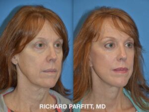 <strong>Procedures: </strong> Facelift/Neck Lift, Forehead/Brow Lift, Upper & Lower Blepharoplasty (Eyelid Surgery) Before and after photo of Facelift, Forehead Lift, Upper Blepharoplasty, Lower Blepharoplasty, eyelid surgery, plastic surgery Madison, WI by Dr. Parfitt - right oblique view