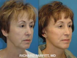 <strong>Procedures: </strong> Facelift/Neck Lift Before and after photo of Facelift, plastic surgery Madison WI by Dr. Parfitt