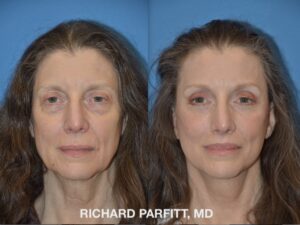 <strong>Procedures: </strong> Facelift/Neck Lift, Forehead/Brow Lift, Lip Lift, Upper & Lower Blepharoplasty (Eyelid Surgery) Facelift / Neck Lift, Forehead /Brow Lift, Upper Lip Lift and Upper and Lower eyelid surgery before and after photo Madison WI front view patient of Dr. Parfitt