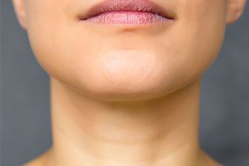 Submental Liposuction