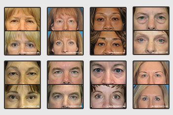 Blepharoplasty Eyelid Surgery