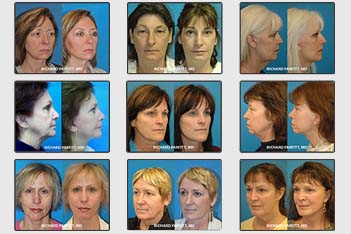Plastic Surgery Facelift procedure