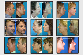 Submental Neck Liposuction Photos