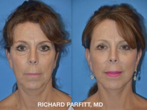 <strong>Procedures: </strong> Face / Neck lift, Upper & Lower Blepharoplasty (Eyelid Surgery) Before and after photo of Facelift and Upper and Lower Blepharoplasty ( eyelid surgery), front side view, by Dr. Parfitt Madison WI