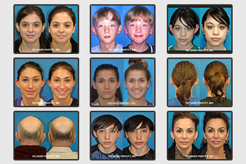 Otoplasty