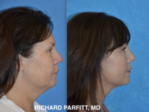 <strong>Procedures: </strong> Facelift/Neck Lift - deep plane with submental and jowl liposuction showing improved lower facial and neck contours by Dr. Richard Parfitt. Patient age 52. Deep-plane facelift and neck lift before and after side-profile photos showing reduced jowling, improved jawline definition, and a smoother neck.
