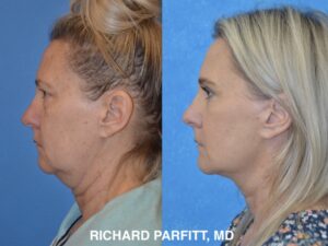 <strong>Procedures: </strong> Facelift/Neck Lift. Before and after photos showing improved jawline definition and a smoother neck profile by Dr. Richard Parfitt. Facelift before and after side-profile photos showing a more defined jawline, reduced neck fullness, and smoother neck contour by Dr. Richard Parfitt.