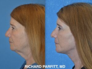 <strong>Procedures: </strong> Facelift/Neck Lift before and after results showing a more defined jawline and smoother neck by Dr. Richard Parfitt. Facelift before and after side-profile photos showing reduced neck sagging, improved jawline definition, and a smoother chin-to-neck contour.