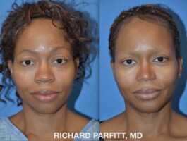 <strong>Procedure: </strong>Rhinoplasty (Nose Job), Chin Implant, Upper & Lower Eyelid Surgery Before and After Photo African American Rhinoplasty, Nose Surgery, Chin Augmentation and Upper and Lower Blepharoplasty, eyelid surgery, plastic surgery by Dr. Parfitt Middleton WI patient