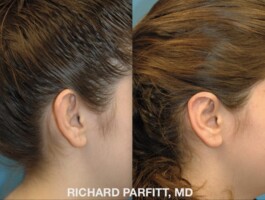 <strong>Procedure: </strong>Otoplasty Before and after picture, side view, young female, Otoplasty (ear-surgery) surgeon is Dr. Richard Parfitt of Madison WI
