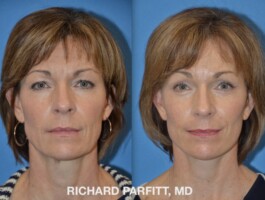 <strong>Procedures: </strong> Facelift/Neck Lift, Forehead/Brow Lift, Upper & Lower Blepharoplasty (Eyelid Surgery) Before and after photo of Facelift, Forehead Lift, Upper Blepharoplasty, Lower Blepharoplasty, eyelid surgery, plastic surgery Madison, WI by Dr. Parfitt