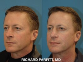 <strong>Procedure: </strong>Rhinoplasty (Nose Job) and Blepharoplasty (eyelids) Male Rhinoplasty and Blepharoplasty age 50 with Dr. Parfitt in Madison Wisconsin
