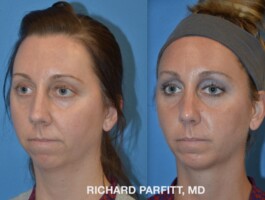 <strong>Procedure: </strong>Rhinoplasty (Nose Job) & Chin Implant Before and After Photo Rhinoplasty, Nose Surgery, Chin Augmentation, Chin Implant, Left Side, plastic surgery by Dr. Parfitt Appleton WI