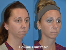 <strong>Procedure: </strong>Rhinoplasty (Nose Job) & Chin Implant Before and After Photo Rhinoplasty, nose surgery, Chin Augmentation, Chin Implant, right view, plastic surgery by Dr. Parfitt Appleton WI