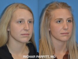 <strong>Procedure: </strong>Rhinoplasty (Nose Job) Rhinoplasty Dr Parfitt WI- Right Oblique - 186