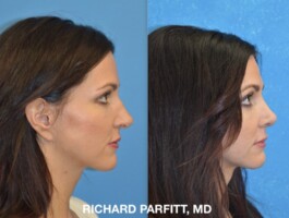 <strong>Procedure: </strong>Rhinoplasty (Nose Job) and Blepharoplasty (eyelids) Correction of nasal bump right side surgery by Dr. Parfitt