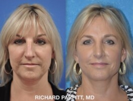 <strong>Procedure: </strong>Rhinoplasty (Nose Job) Rhinoplasty performed by Dr. Parfitt front view