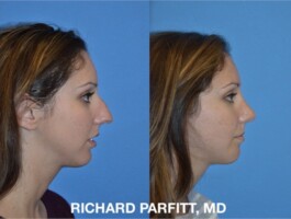 Correction of Beak nose side view - Rhinoplasty