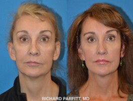 <strong>Procedures: Revision Rhinoplasty, Lower Blepharoplasty, Upper Lip Lift</strong> Revision Rhinoplasty, Lower Blepharoplasty, Upper Lip Lift